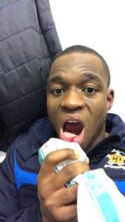 Cambridge United's MOTM Uche Loses Tooth, Rushed To The Dentist